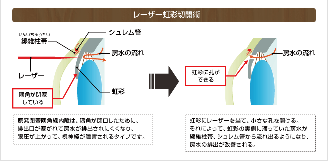 レーザー虹彩切開術