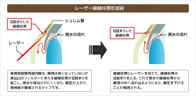 レーザー線維柱帯形成術