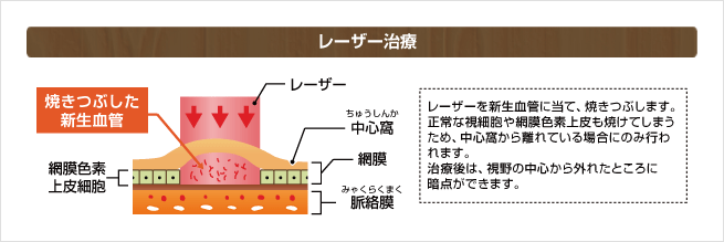 レーザー治療