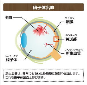 硝子体出血