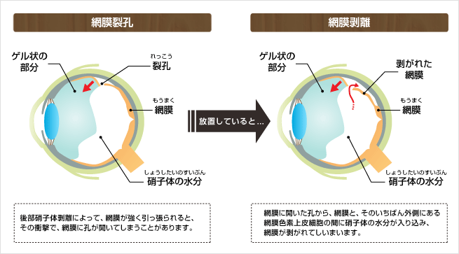 網膜剥離の原因