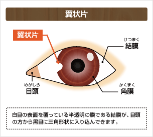 翼状片